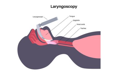 Laringoskopi tıbbi prosedürü. Katı bir endoskop kullanarak gırtlağın ve ses tellerinin görselleştirilmesi. Nefes yolu tıkanıklığının teşhisi, ses telleri ve boğaz değerlendirme vektörünün patolojisi.