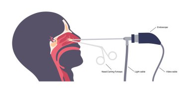 Hipofiz bezi ameliyatı. Minimum invaziv endoskopik transfenoidal prosedür. Hipofiz bezleri, adenomlar alınıyor. Burun boşluğundan hipofiz bezine ulaşılıyor.