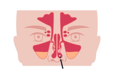 Burun endoskopisi, minimum invaziv tanı prosedürü. Katı endoskop. Burun boşluğu, sinüsler ve nazofarenks muayenesi. Kronik sinüzit, burun polipsi, septum sapması veya tümör düz vektörü.