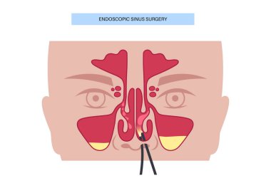 Burun endoskopisi, minimum invaziv tanı prosedürü. Esnek endoskop. Burun boşluğu, sinüsler ve nazofarenks muayenesi. Kronik sinüzit, burun polipsi, septum sapması veya tümör düz vektörü.