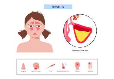 Sinüzit posteri. Paranazal sinüslerin mukozal astarı iltihaplanmış. Viral ya da bakteriyel enfeksiyonlar. Burun tıkanıklığı, yüz basıncı, baş ağrısı, ateş ve gergedan anatomik düz vektör.