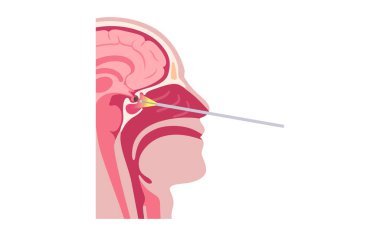 Hipofiz bezi ameliyatı. Minimum invaziv endoskopik transfenoidal prosedür. Hipofiz bezleri, adenomlar alınıyor. Burun boşluğundan hipofiz bezine ulaşılıyor.
