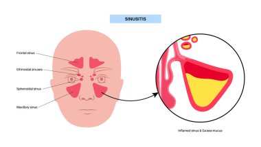 Sinüzit posteri. Paranazal sinüslerin mukozal astarı iltihaplanmış. Viral ya da bakteriyel enfeksiyonlar. Burun tıkanıklığı, yüz basıncı, baş ağrısı, ateş ve gergedan anatomik düz vektör.