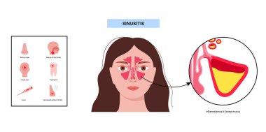 Sinüzit posteri. Paranazal sinüslerin mukozal astarı iltihaplanmış. Viral ya da bakteriyel enfeksiyonlar. Burun tıkanıklığı, yüz basıncı, baş ağrısı, ateş ve gergedan anatomik düz vektör.