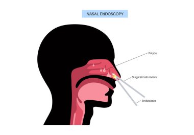 Burun endoskopisi, minimum invaziv tanı prosedürü. Katı endoskop. Burun boşluğu, sinüsler ve nazofarenks muayenesi. Kronik sinüzit, burun polipsi, septum sapması veya tümör düz vektörü.