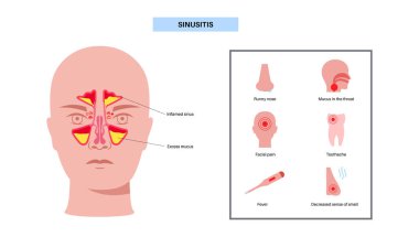 Sinüzit posteri. Paranazal sinüslerin mukozal astarı iltihaplanmış. Viral ya da bakteriyel enfeksiyonlar. Burun tıkanıklığı, yüz basıncı, baş ağrısı, ateş ve gergedan anatomik düz vektör.