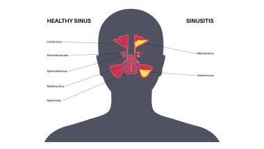 Sinüzit posteri. Paranazal sinüslerin mukozal astarı iltihaplanmış. Viral ya da bakteriyel enfeksiyonlar. Burun tıkanıklığı, yüz basıncı, baş ağrısı, ateş ve gergedan anatomik düz vektör.