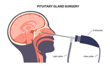 Hipofiz bezi ameliyatı. Minimum invaziv endoskopik transfenoidal prosedür. Hipofiz bezleri, adenomlar alınıyor. Burun boşluğundan hipofiz bezine ulaşılıyor.