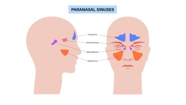 Sinüzit tıbbi afişi. Paranazal sinüslerin mukozal astarı iltihaplanmış. Viral ya da bakteriyel enfeksiyonlar. Burun tıkanıklığı, yüz basıncı, baş ağrısı ve ateş düz vektör çizimi