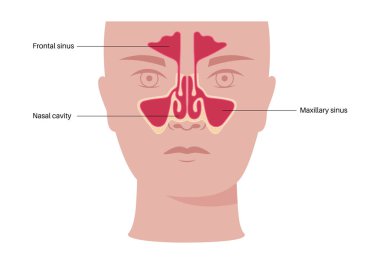 Sinüzit tıbbi afişi. Paranazal sinüslerin mukozal astarı iltihaplanmış. Viral ya da bakteriyel enfeksiyonlar. Burun tıkanıklığı, yüz basıncı, baş ağrısı ve ateş düz vektör çizimi