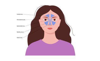 Sinüzit tıbbi afişi. Paranazal sinüslerin mukozal astarı iltihaplanmış. Viral ya da bakteriyel enfeksiyonlar. Burun tıkanıklığı, yüz basıncı, baş ağrısı ve ateş düz vektör çizimi