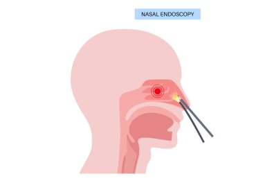 Burun endoskopisi, minimum invaziv tanı prosedürü. Katı endoskop. Burun boşluğu, sinüsler ve nazofarenks muayenesi. Kronik sinüzit, burun polipsi, septum sapması veya tümör düz vektörü.