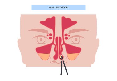 Burun endoskopisi, minimum invaziv tanı prosedürü. Esnek endoskop. Burun boşluğu, sinüsler ve nazofarenks muayenesi. Kronik sinüzit, burun polipsi, septum sapması veya tümör düz vektörü.