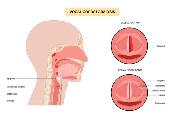 Vocal cords paralysis, laryngeal disorder caused by nerve dysfunction. Impairing voice, breathing, and swallowing. Laryngoscopy concept. Rehabilitation for airway and speech restoration medical vector