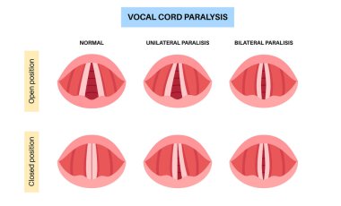 Ses telleri felci, sinir bozukluğundan kaynaklanan gırtlak rahatsızlığı. Sesi, nefesi ve yutkunmasını engelliyor. Laringoskopi konsepti. Solunum yolu ve konuşma yenileme tıbbi vektörü için rehabilitasyon