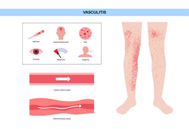Vasculitis medical poster. Autoimmune disease, inflammation of blood vessels, swelling, tissue damage, and potential organ dysfunction. Diagnosis and appropriate treatment flat vector illustration
