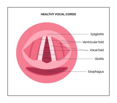 Ses telleri tıbbi afiş. Gırtlak anatomisi, gırtlak iltihabı, hava akışı ve ses çıkarma. ENT konsepti, otolaringoloji ve konuşma terapisi. Teşhis, stroboskopi ve solunum tıbbı vektörü cerrahi eğitimi