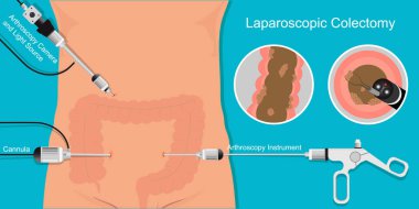 Laparoscopic colectomy surgery is inserted into the abdomen to remove the cancerous parts of the colon.The advantages of laparoscopic colectomy clipart