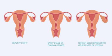 Stage of ovarian cancer. clipart