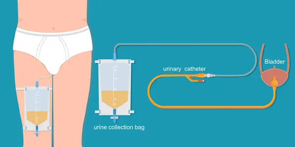 stock vector Urinary catheter in the male body with urinary leg bag.