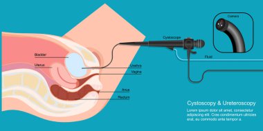 Cystoscopy used to examine urethra and bladder. clipart