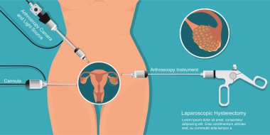 Laparoscopic fibroid removal is a minimally invasive procedure to remove uterine fibroids. clipart