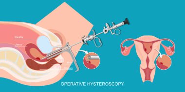Operatif histeroskopi, minimal invaziv jinekolojik bir prosedürdür..