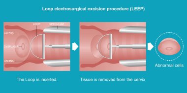 LEEP (döngü elektroseksizyon prosedürü).