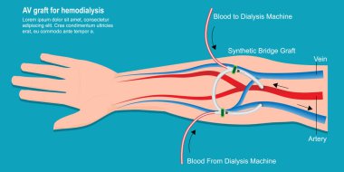 An arteriovenous (AV) graft is a type of access used for hemodialysis. clipart