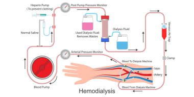 Hemodiyaliz atıkları ve suyu filtrelemek için bir tedavidir..