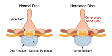 Disk diski disk çekirdeğinin bir parçasıdır..
