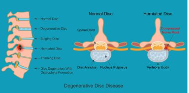 Dejeneratif Disk Hastalığı disk çekirdeğinin bir parçasıdır.