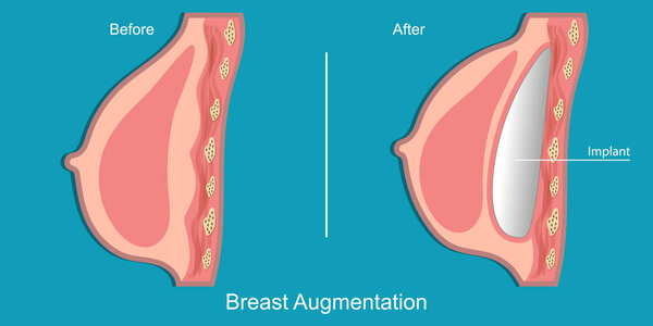 Увеличение груди осуществляется путем установки имплантатов.