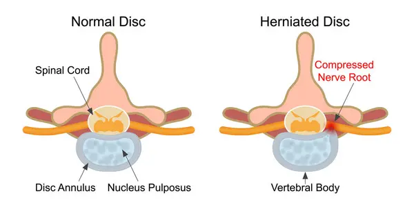 stock vector Herniated disc is a fragment of the disc nucleus.