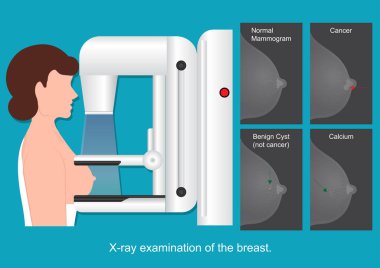 Göğüs röntgeni..