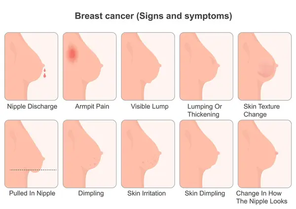 stock vector Warning signs and symptoms of Breast cancer.