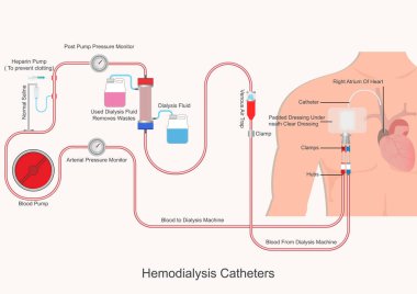 Hemodiyaliz sondaları böbreğin önemli bir parçasıdır..