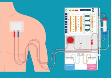 Hemodialysis is a process of filtering the blood of a person. clipart