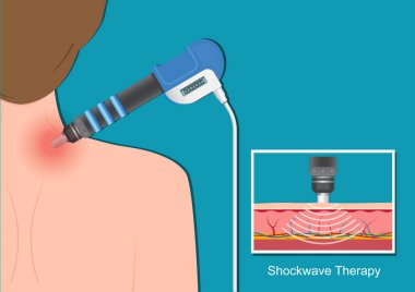 Extracorporeal Shock Wave Therapy. clipart