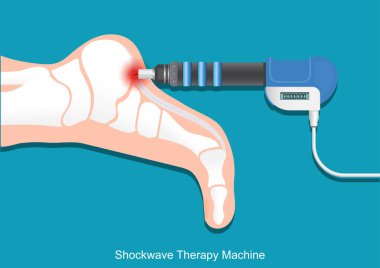 ESWT or Extracorporeal shock wave therapy. clipart