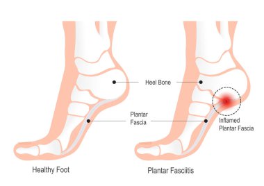 Plantar fasiit, plantar fasiadaki iltihaplanmadır..