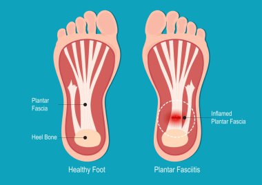 Plantar fasiiti en yaygın ortopedik hastalıklardan biridir..
