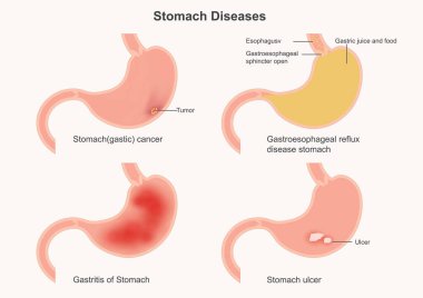 Arka planda izole edilmiş mide hastalıkları.