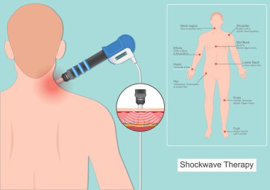 Extracorporeal Shock Wave Therapy (kısaca ESWT).