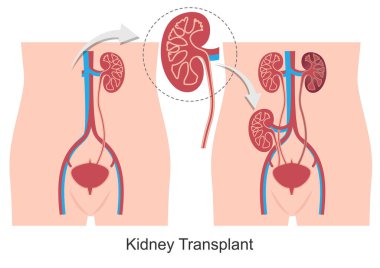 Böbrek nakli, hastalıklı veya yaralı bir böbreği değiştirmek için yapılan bir ameliyattır. .