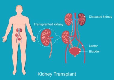 Böbrek nakli sağlıklı bir böbrek için yapılan bir ameliyattır..