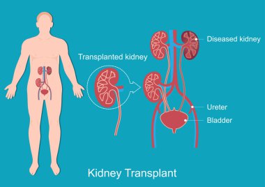 Kidney transplant is a surgery to place a healthy kidney. clipart