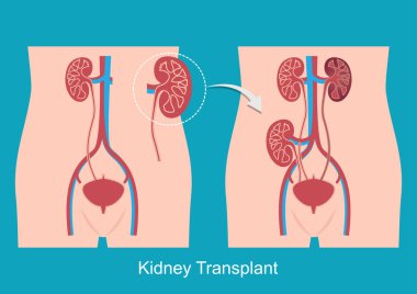 Böbrek nakli, vücuda yeni bir böbrek nakli gerektirir.. 