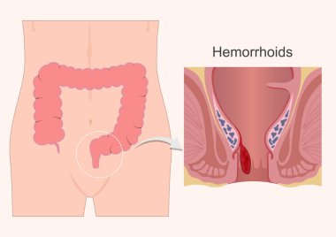 Hemorrhoids or piles are anal cushions. clipart