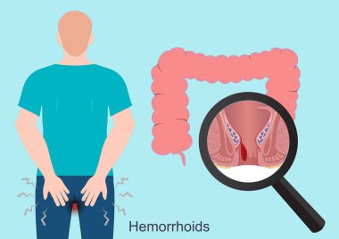 Hemorrhoids or piles are common irritations. clipart